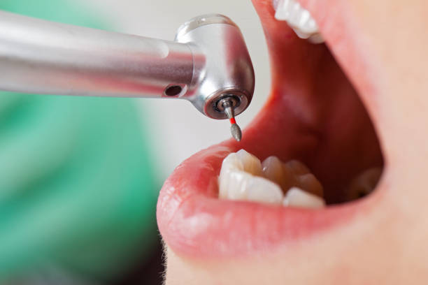 Best Urgent Care for Lost Fillings or Crowns in Roundup, MT